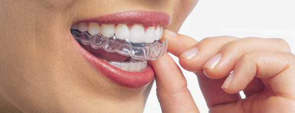 Invisalign Teen Toronto